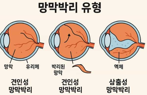 망막박리-종류