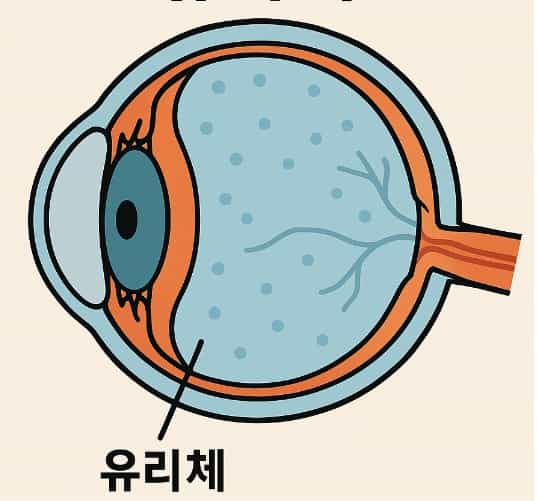 망막박리-치료방법-유리체절제술